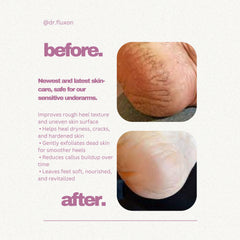 Dr. Fluxon 20% Urea Foot Cream Roll-on (50ml) – Intensive Repair for Dry & Cracked Heels with Lactic Acid & Vitamin E