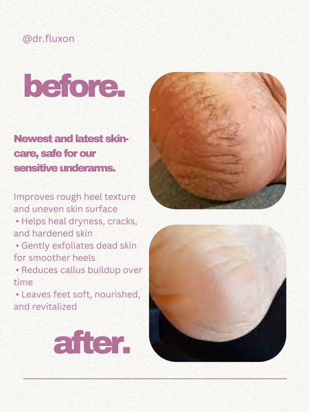 Dr. Fluxon 20% Urea Foot Cream Roll-on (50ml) – Intensive Repair for Dry & Cracked Heels with Lactic Acid & Vitamin E